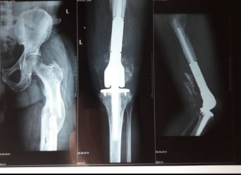xray of a successful Total Knee Replacement