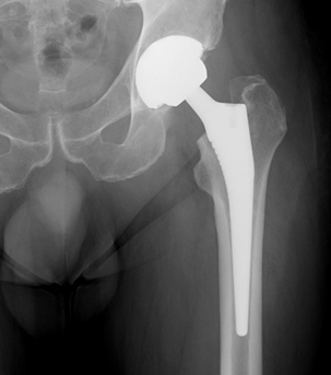 xray of a successful Total Hip Replacement