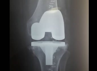 xray of a successful Total Knee Replacement